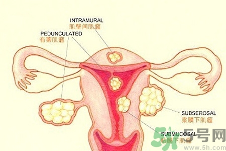 ?子宮移位怎么治療？子宮移位能懷孕嗎？