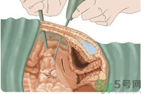 子宮移位的原因是什么？子宮移位的癥狀有哪些？