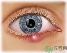 眼皮里長了個(gè)疙瘩是怎么回事?眼睛里長了個(gè)小白點(diǎn)怎么辦? 眼皮里長了個(gè)疙瘩是怎么回事?眼睛里長了個(gè)小白點(diǎn)怎么辦?