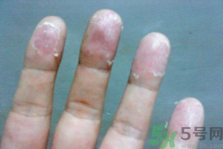 ?手掌脫皮的危害有哪些？如何預防手掌脫皮？