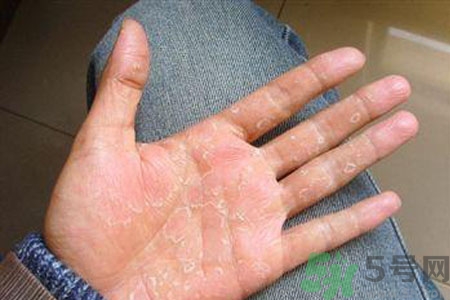 ?手掌脫皮的危害有哪些？如何預防手掌脫皮？