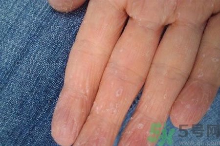 ?手掌脫皮的危害有哪些？如何預防手掌脫皮？