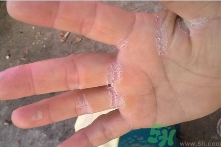 ?手掌脫皮的危害有哪些？如何預防手掌脫皮？
