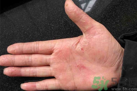 手脫皮是什么原因？手脫皮的治療方法是什么？