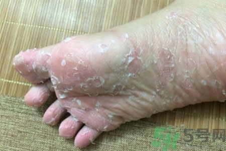 腳脫皮是怎么回事？腳脫皮怎么辦？