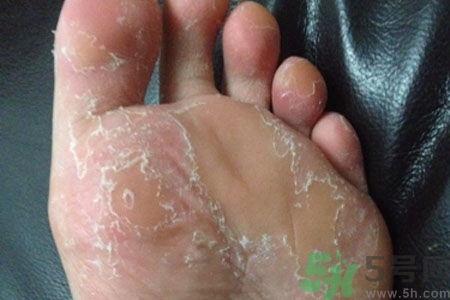腳脫皮是怎么回事？腳脫皮怎么辦？