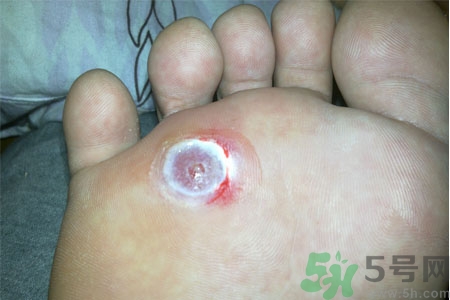 雞眼如何去除？腳上長了雞眼怎么治療？