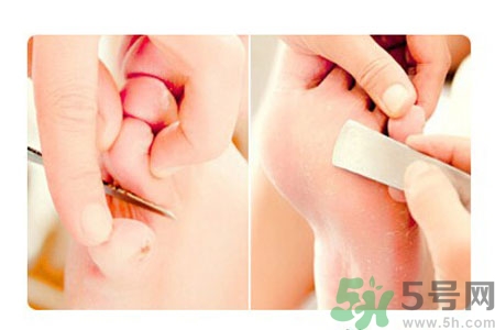 雞眼如何去除？腳上長了雞眼怎么治療？