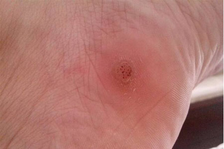 雞眼如何去除？腳上長了雞眼怎么治療？