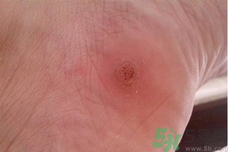 腳上長(zhǎng)雞眼是怎么回事？腳上長(zhǎng)雞眼是怎么辦？