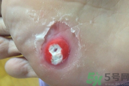 腳上長(zhǎng)雞眼是怎么回事？腳上長(zhǎng)雞眼是怎么辦？