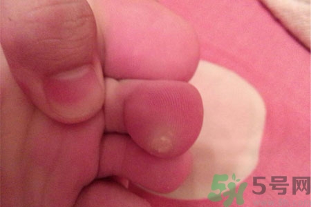 雞眼怎么能徹底根治？如何預防腳上長雞眼？