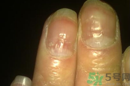 孩子手指甲凹凸不平是什么原因？手指甲凹凸不平的原因是什么？