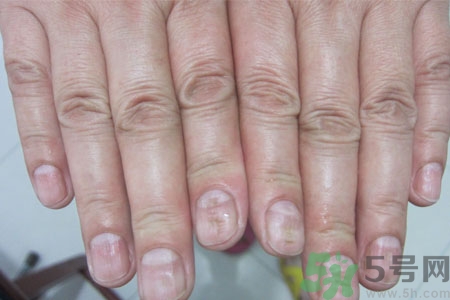 孩子手指甲凹凸不平是什么原因？手指甲凹凸不平的原因是什么？