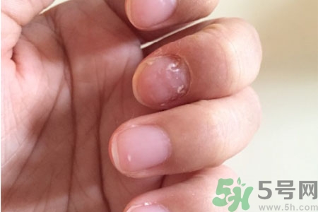 孩子手指甲凹凸不平是什么原因？手指甲凹凸不平的原因是什么？