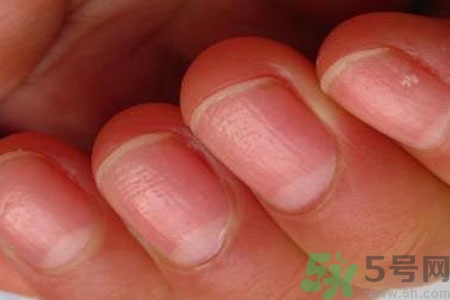 手指甲凹凸不平是怎么回事？如何預(yù)防手指甲凹凸不平？