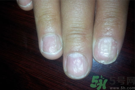 手指甲凹凸不平是怎么回事？如何預(yù)防手指甲凹凸不平？