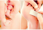 雞眼如何去除？腳上長(zhǎng)了雞眼怎么治療？