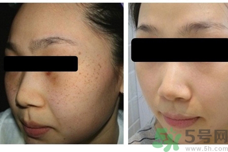 激光縮毛孔多少錢一次？激光縮毛孔一個療程多少錢？