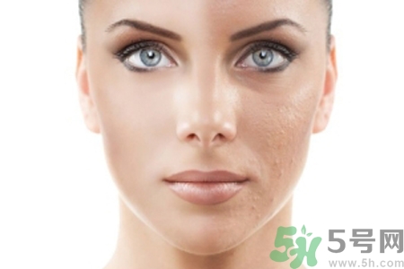 激光縮毛孔多少錢一次？激光縮毛孔一個療程多少錢？