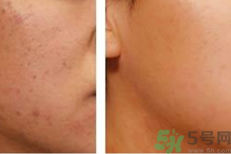毛孔粗大的原因是什么？激光可以改善毛孔粗大嗎？