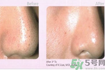 毛孔粗大的原因是什么？激光可以改善毛孔粗大嗎？