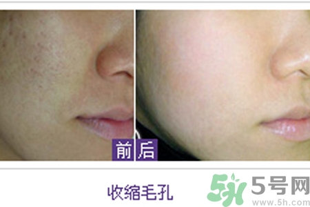 毛孔粗大的原因是什么？激光可以改善毛孔粗大嗎？