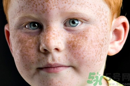 臉上長雀斑吃什么好？有雀斑不能吃什么？