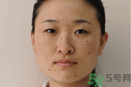 臉上長雀斑吃什么好？有雀斑不能吃什么？