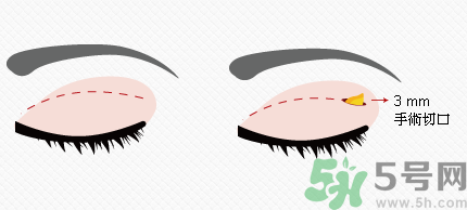 提眉術(shù)后多久可以恢復(fù)？提眉術(shù)后全過程照片