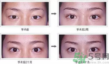 提眉術(shù)后多久可以恢復(fù)？提眉術(shù)后全過程照片