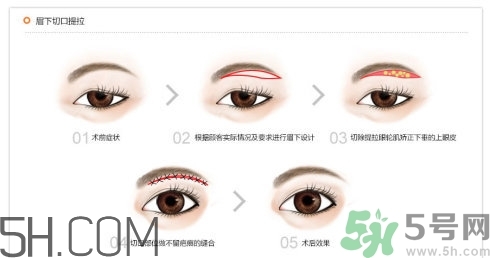 切眉手術(shù)后老得快嗎？切眉能保持多久？