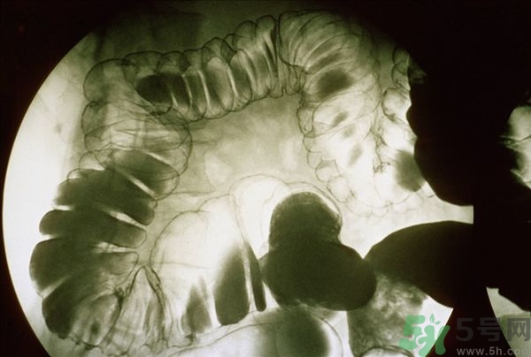 腸炎肚子疼怎么辦？腸炎肚子疼怎么緩解？