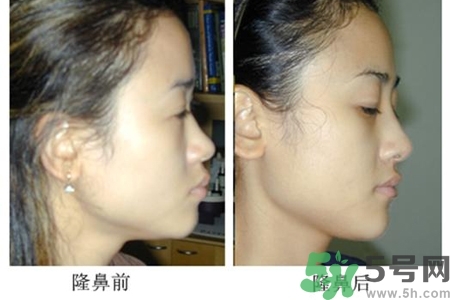 玻尿酸隆鼻的危害有哪些？玻尿酸隆鼻的副作用是什么？