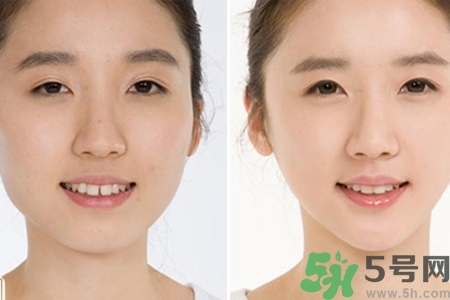 玻尿酸隆鼻的危害有哪些？玻尿酸隆鼻的副作用是什么？