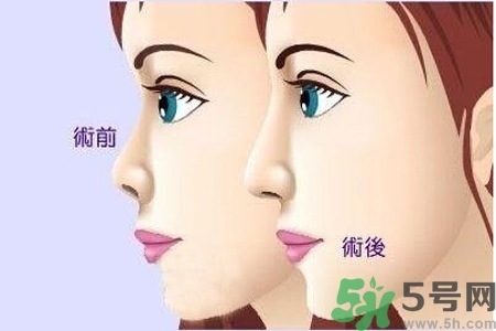 玻尿酸隆鼻的缺點是什么？玻尿酸隆鼻的優(yōu)點有哪些？