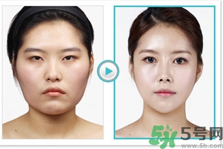 玻尿酸隆鼻的缺點是什么？玻尿酸隆鼻的優(yōu)點有哪些？