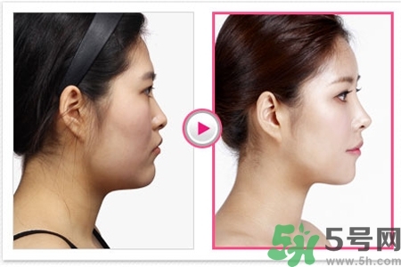 玻尿酸隆鼻的缺點是什么？玻尿酸隆鼻的優(yōu)點有哪些？