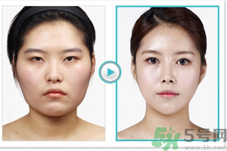 玻尿酸隆鼻和手術(shù)隆鼻的區(qū)別是什么？