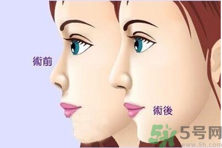 玻尿酸隆鼻和手術(shù)隆鼻的區(qū)別是什么？