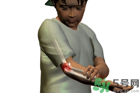 幼年關(guān)節(jié)炎的好發(fā)年齡？幼年關(guān)節(jié)炎別輕易忽視