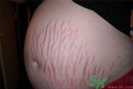妊娠紋癢是怎么回事？妊娠紋癢怎么辦？