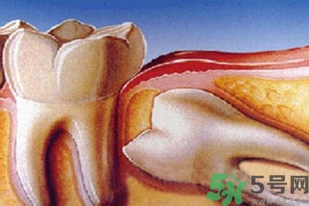 智齒橫著長(zhǎng)怎么辦？智齒橫著長(zhǎng)一定要拔了嗎？
