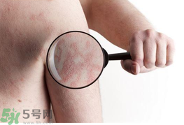 痱子和汗斑的區(qū)別 汗斑用什么藥擦最有效 痱子和汗斑的區(qū)別 汗斑用什么藥擦最有效