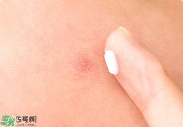 獅王祛痘膏怎么樣？獅王祛痘好用嗎？