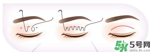 雙眼皮手術哪種最好？割雙眼皮后注意些什么？