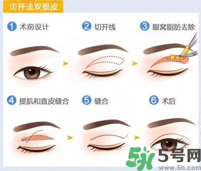 雙眼皮手術哪種最好？割雙眼皮后注意些什么？