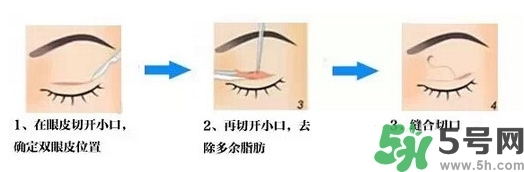 雙眼皮手術哪種最好？割雙眼皮后注意些什么？