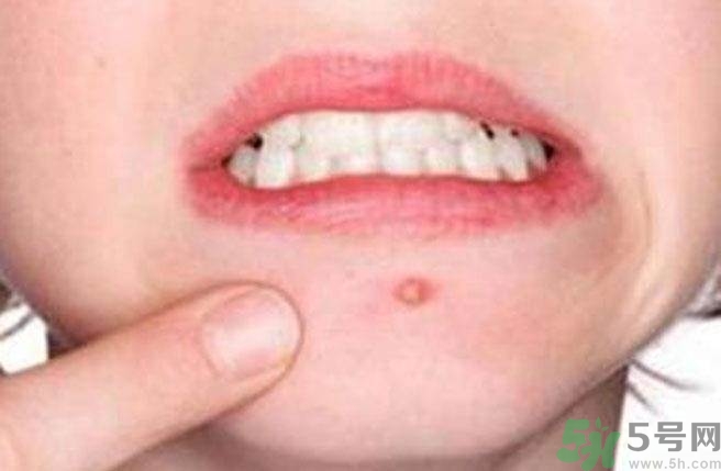 什么樣的痘痘能擠？哪些痘痘不能擠？