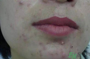 什么樣的痘痘能擠？哪些痘痘不能擠？